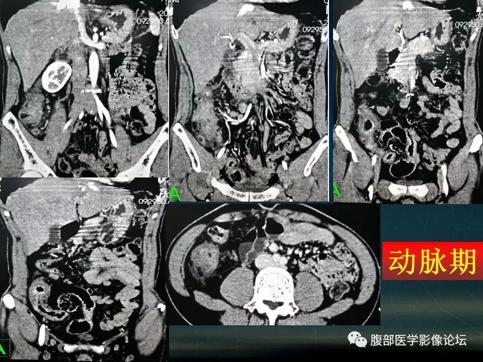 【PPT】小肠疾病读片—克罗恩病、肠结核、溃疡性结肠炎鉴别诊断