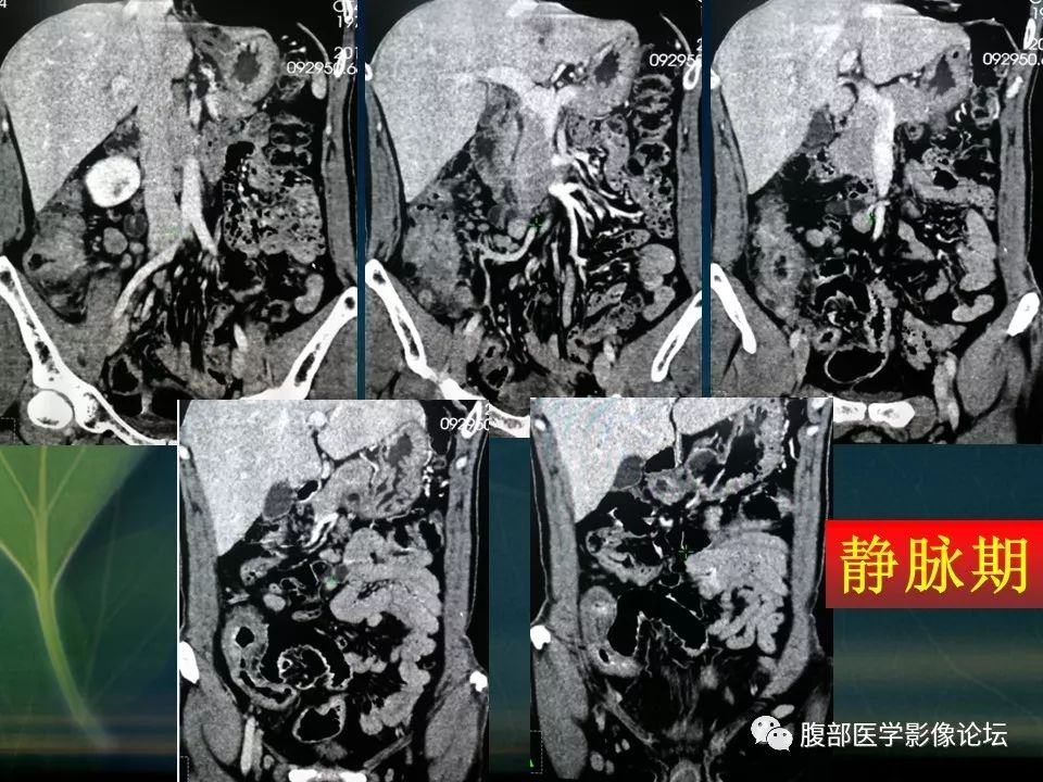 【PPT】小肠疾病读片—克罗恩病、肠结核、溃疡性结肠炎鉴别诊断