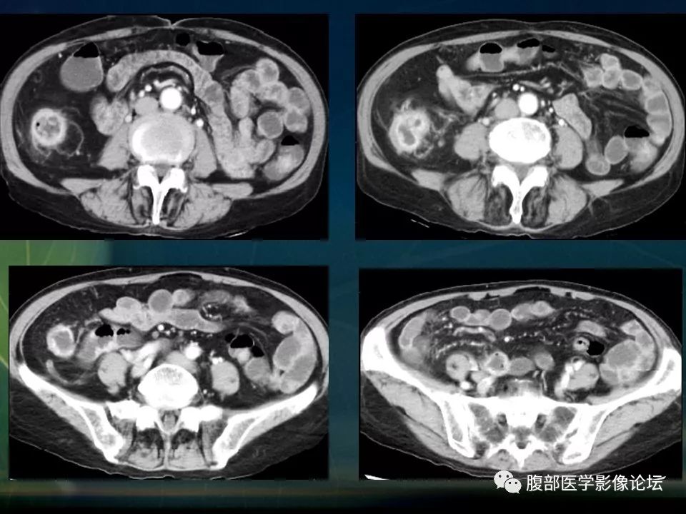 【PPT】小肠疾病读片—克罗恩病、肠结核、溃疡性结肠炎鉴别诊断