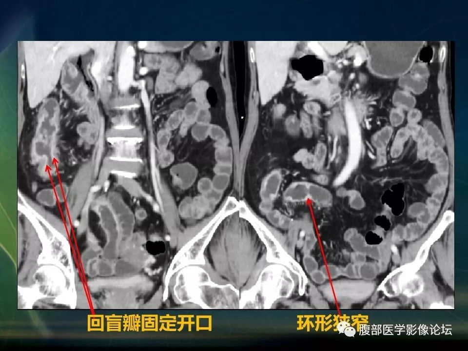 【PPT】小肠疾病读片—克罗恩病、肠结核、溃疡性结肠炎鉴别诊断
