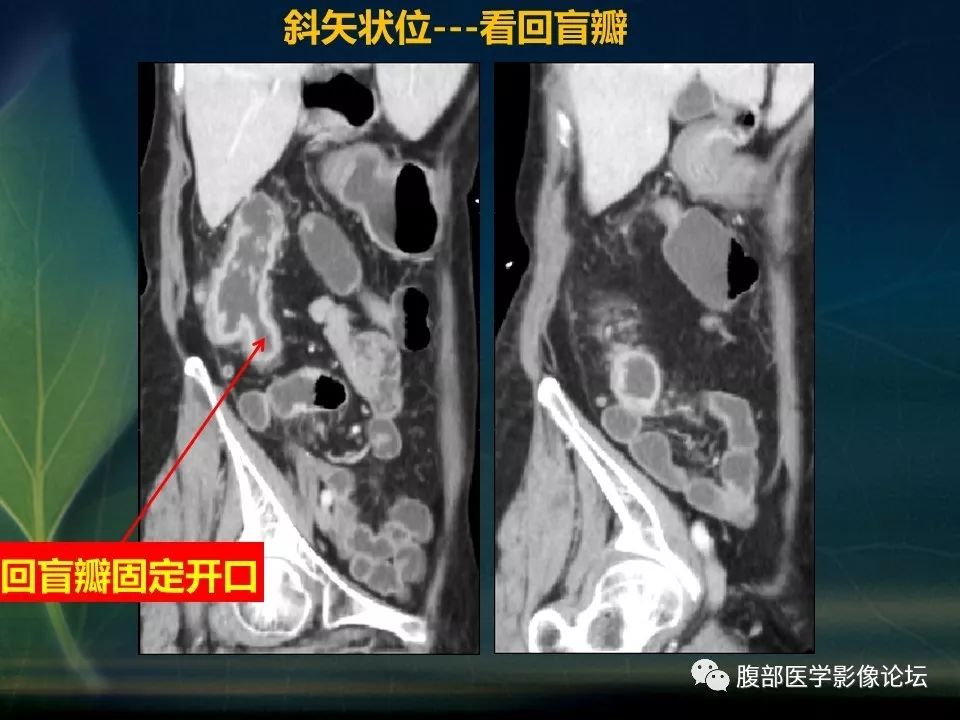 【PPT】小肠疾病读片—克罗恩病、肠结核、溃疡性结肠炎鉴别诊断