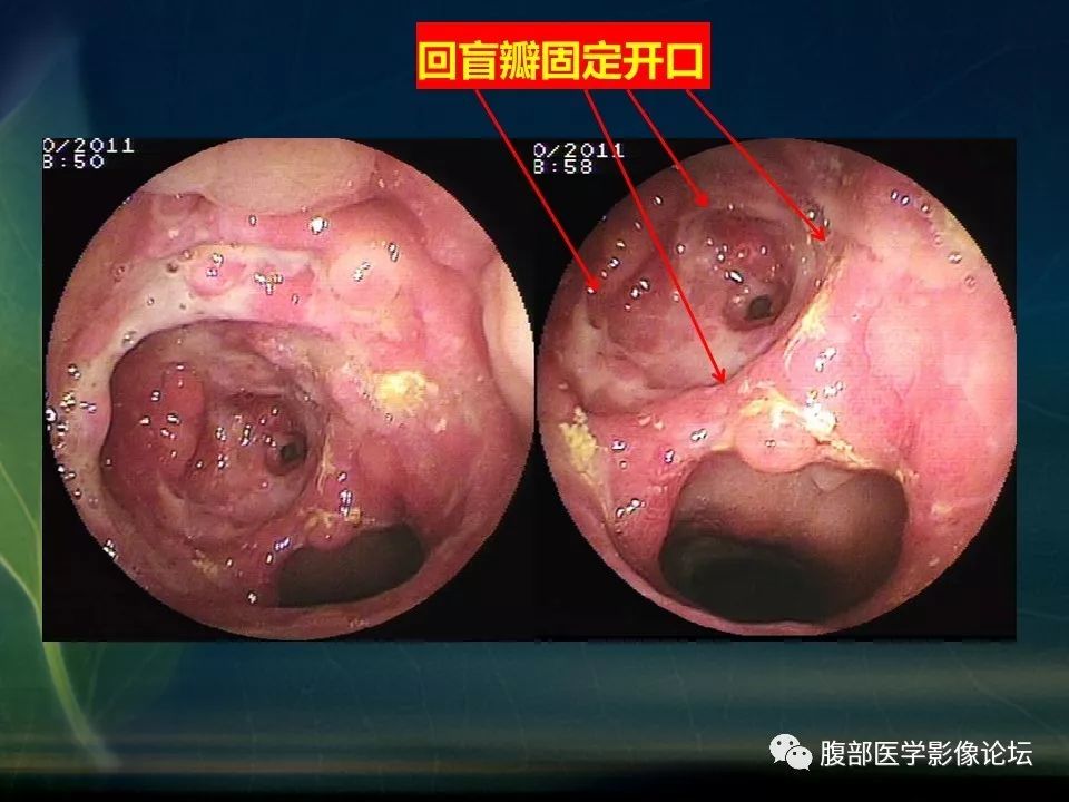 【PPT】小肠疾病读片—克罗恩病、肠结核、溃疡性结肠炎鉴别诊断