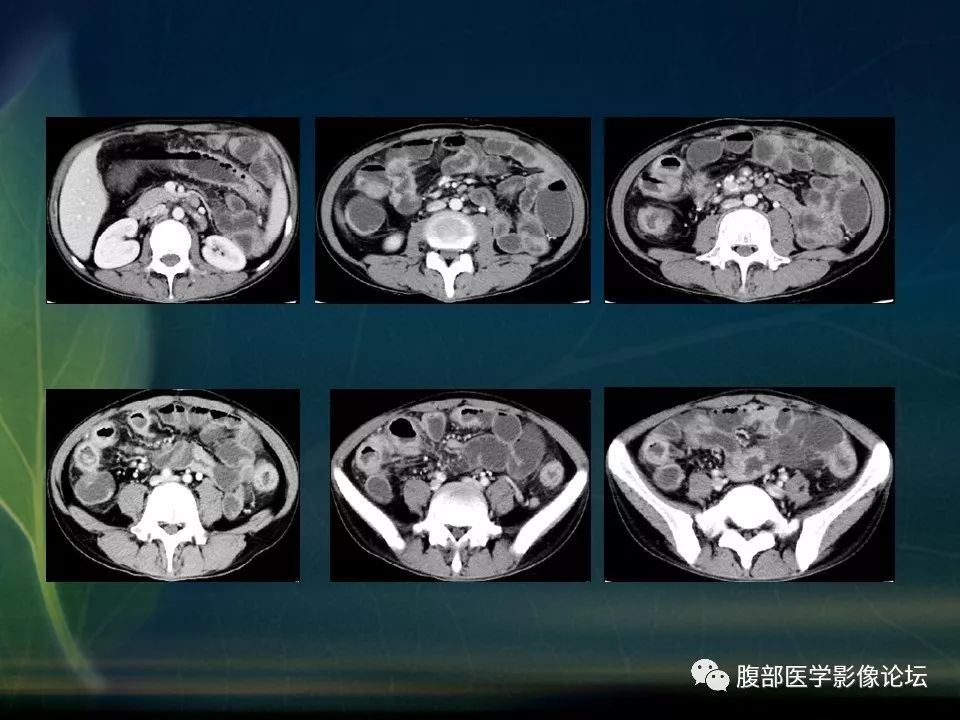 【PPT】小肠疾病读片—克罗恩病、肠结核、溃疡性结肠炎鉴别诊断
