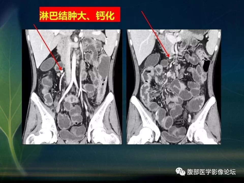 【PPT】小肠疾病读片—克罗恩病、肠结核、溃疡性结肠炎鉴别诊断