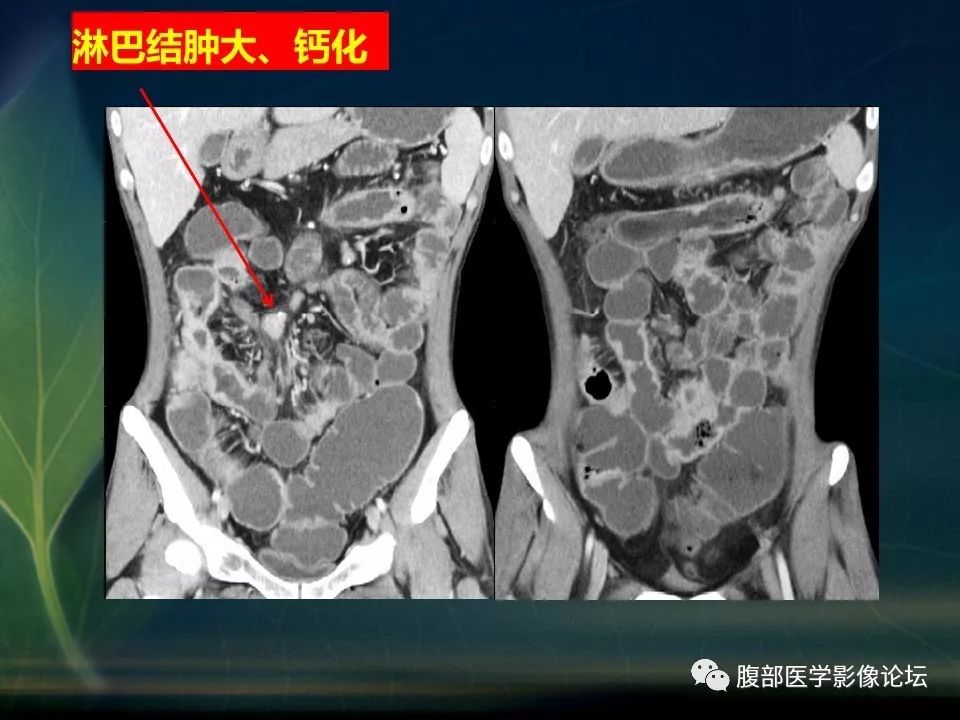 【PPT】小肠疾病读片—克罗恩病、肠结核、溃疡性结肠炎鉴别诊断