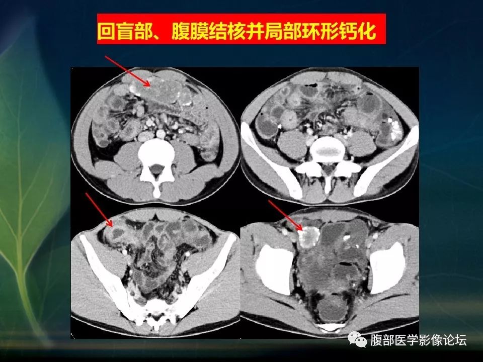 【PPT】小肠疾病读片—克罗恩病、肠结核、溃疡性结肠炎鉴别诊断