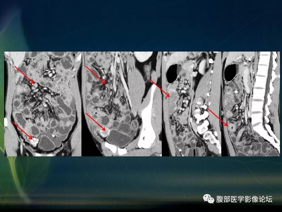 【PPT】小肠疾病读片—克罗恩病、肠结核、溃疡性结肠炎鉴别诊断