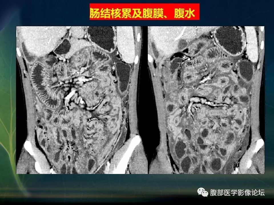 【PPT】小肠疾病读片—克罗恩病、肠结核、溃疡性结肠炎鉴别诊断
