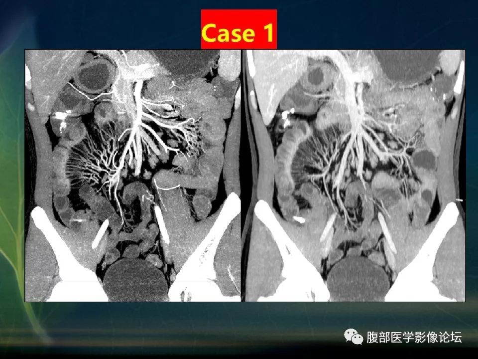 【PPT】小肠疾病读片—克罗恩病、肠结核、溃疡性结肠炎鉴别诊断