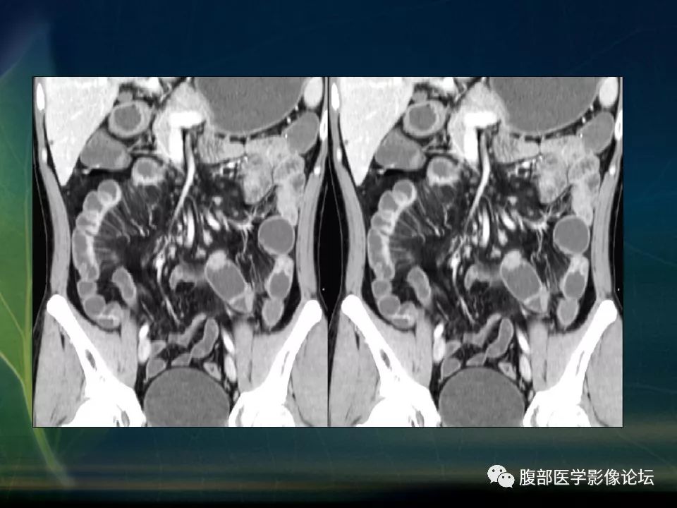 【PPT】小肠疾病读片—克罗恩病、肠结核、溃疡性结肠炎鉴别诊断