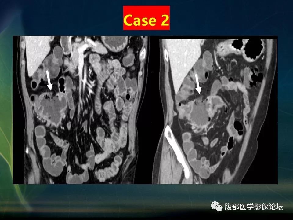 【PPT】小肠疾病读片—克罗恩病、肠结核、溃疡性结肠炎鉴别诊断