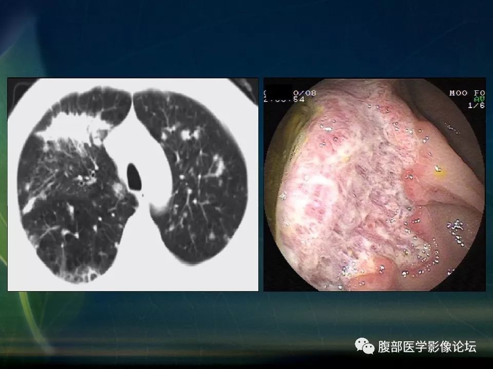 【PPT】小肠疾病读片—克罗恩病、肠结核、溃疡性结肠炎鉴别诊断