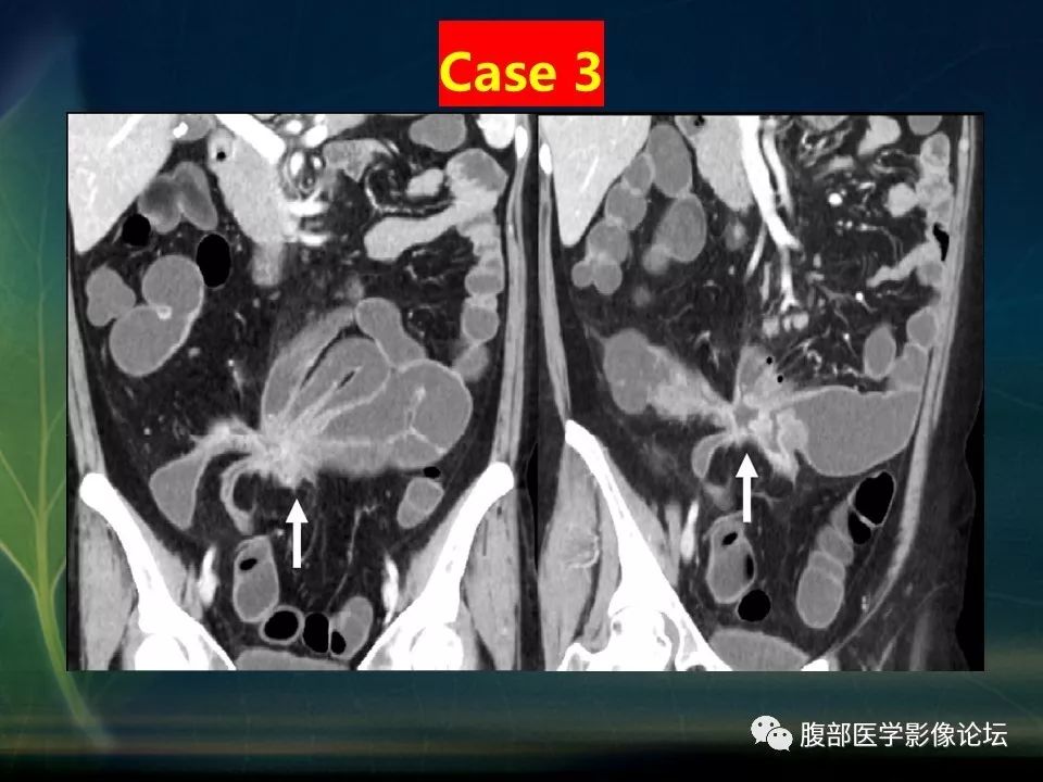 【PPT】小肠疾病读片—克罗恩病、肠结核、溃疡性结肠炎鉴别诊断