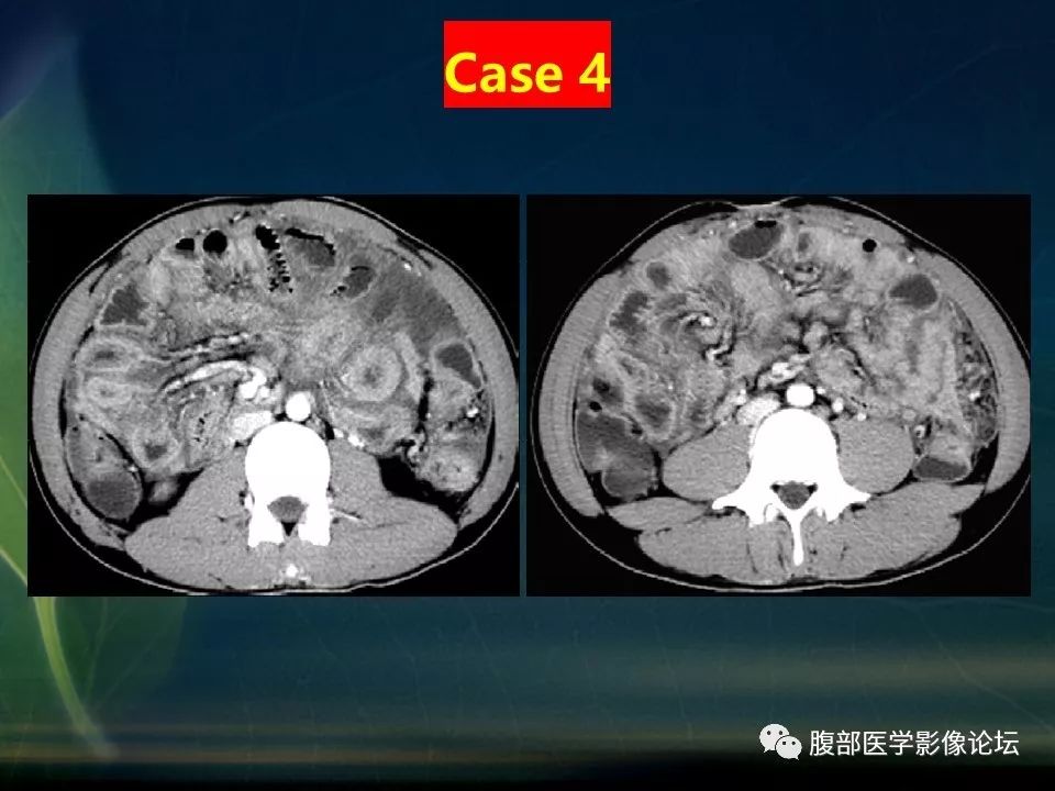 【PPT】小肠疾病读片—克罗恩病、肠结核、溃疡性结肠炎鉴别诊断