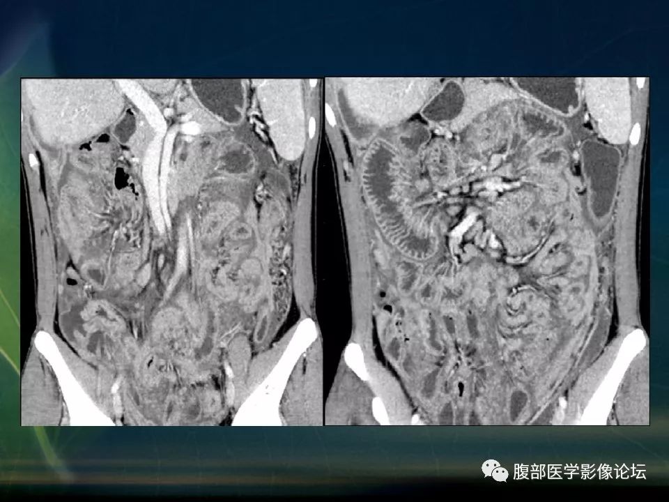 【PPT】小肠疾病读片—克罗恩病、肠结核、溃疡性结肠炎鉴别诊断