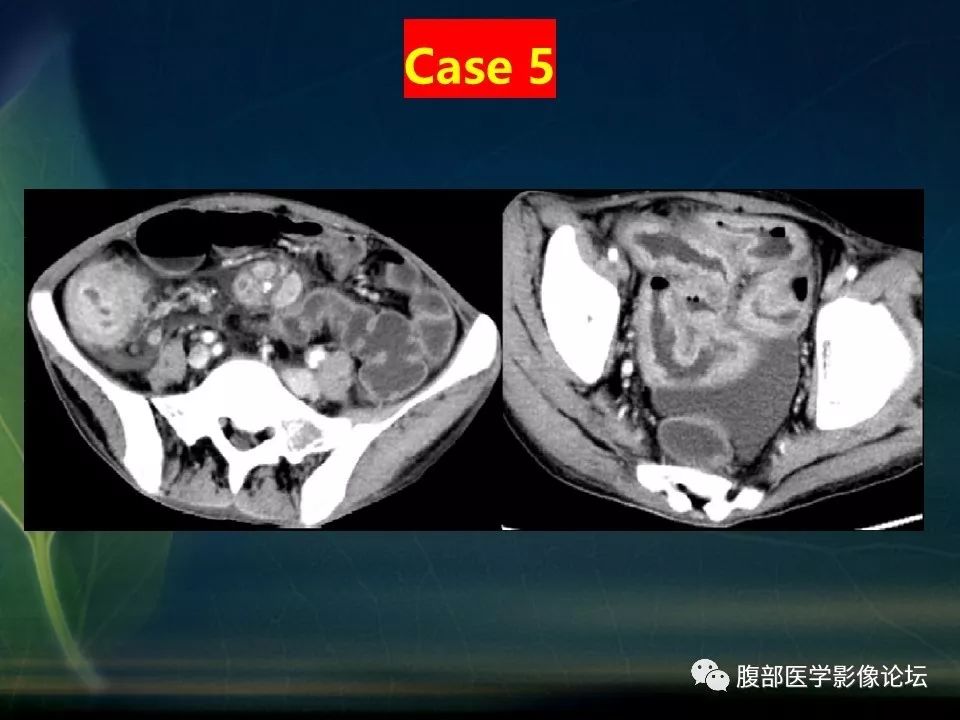 【PPT】小肠疾病读片—克罗恩病、肠结核、溃疡性结肠炎鉴别诊断