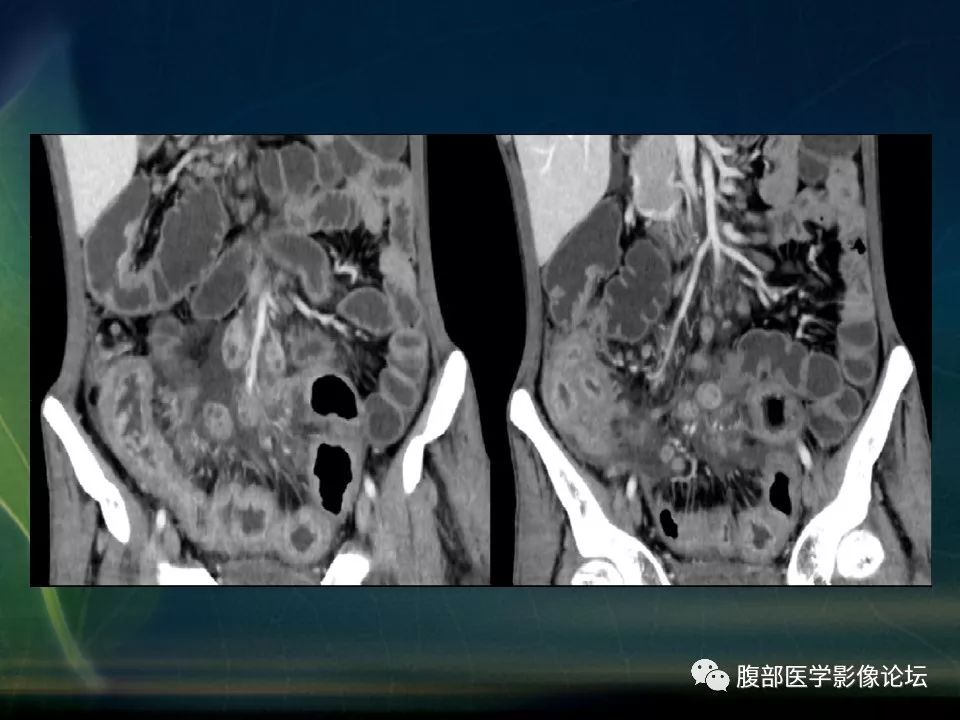 【PPT】小肠疾病读片—克罗恩病、肠结核、溃疡性结肠炎鉴别诊断
