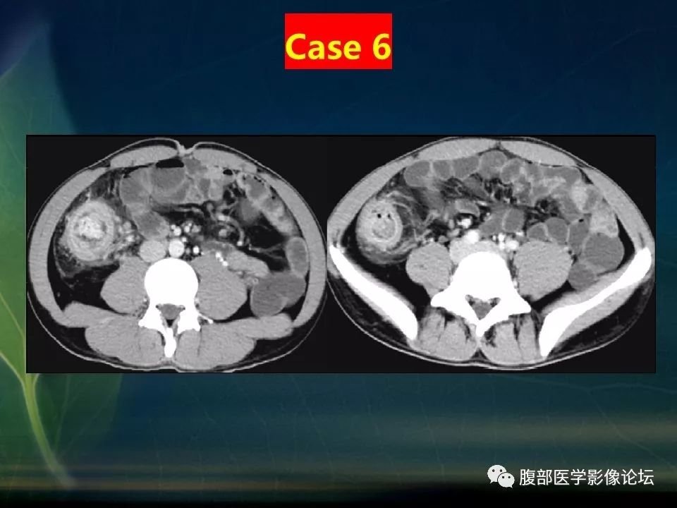 【PPT】小肠疾病读片—克罗恩病、肠结核、溃疡性结肠炎鉴别诊断