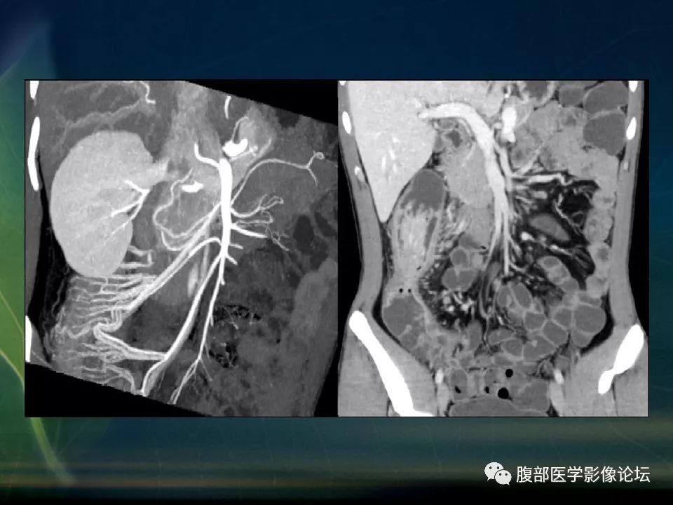 【PPT】小肠疾病读片—克罗恩病、肠结核、溃疡性结肠炎鉴别诊断