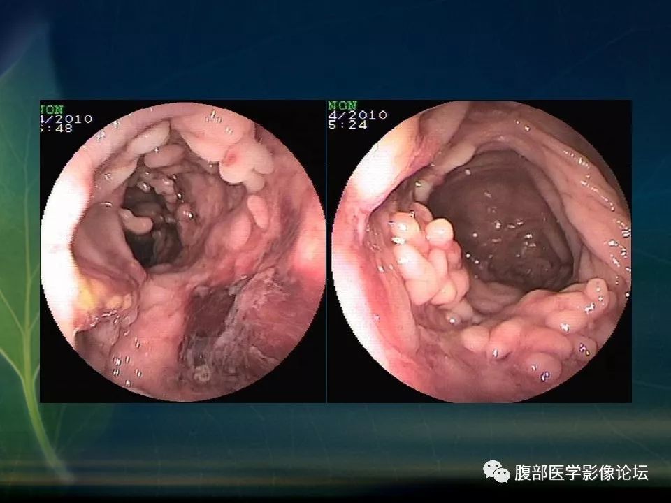 【PPT】小肠疾病读片—克罗恩病、肠结核、溃疡性结肠炎鉴别诊断
