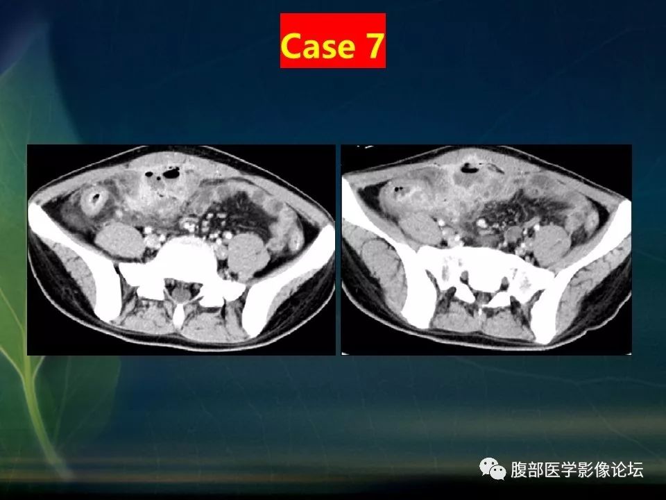 【PPT】小肠疾病读片—克罗恩病、肠结核、溃疡性结肠炎鉴别诊断