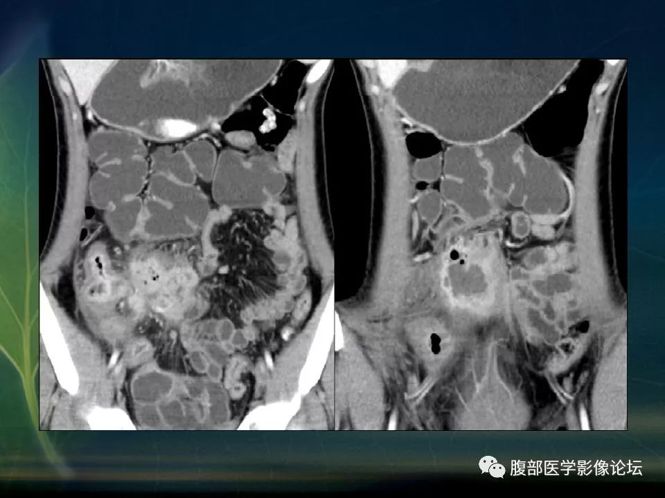 【PPT】小肠疾病读片—克罗恩病、肠结核、溃疡性结肠炎鉴别诊断
