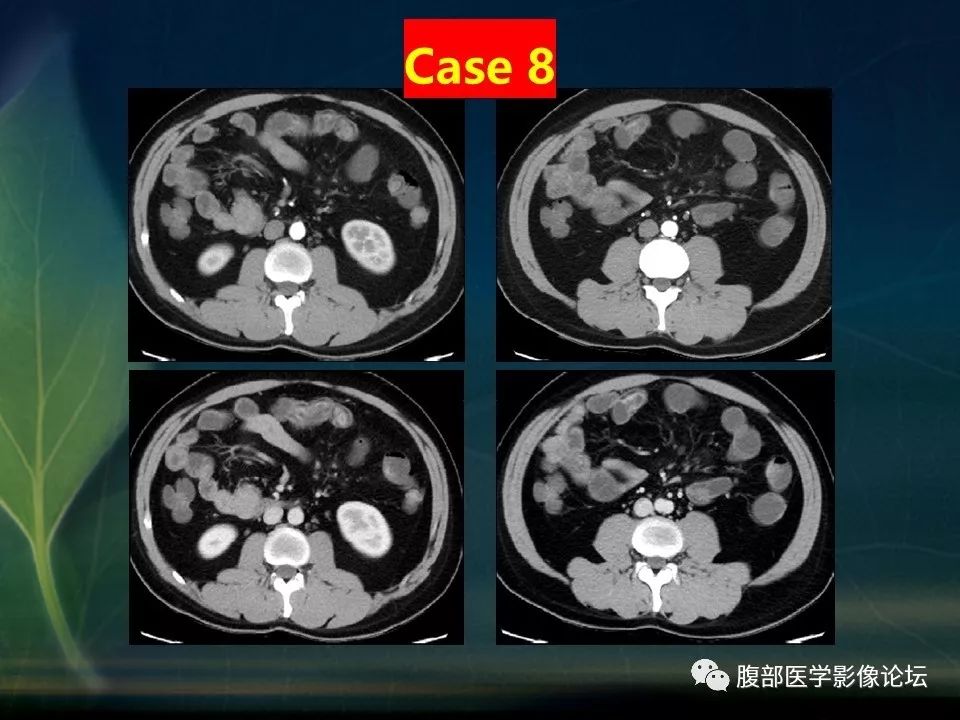 【PPT】小肠疾病读片—克罗恩病、肠结核、溃疡性结肠炎鉴别诊断