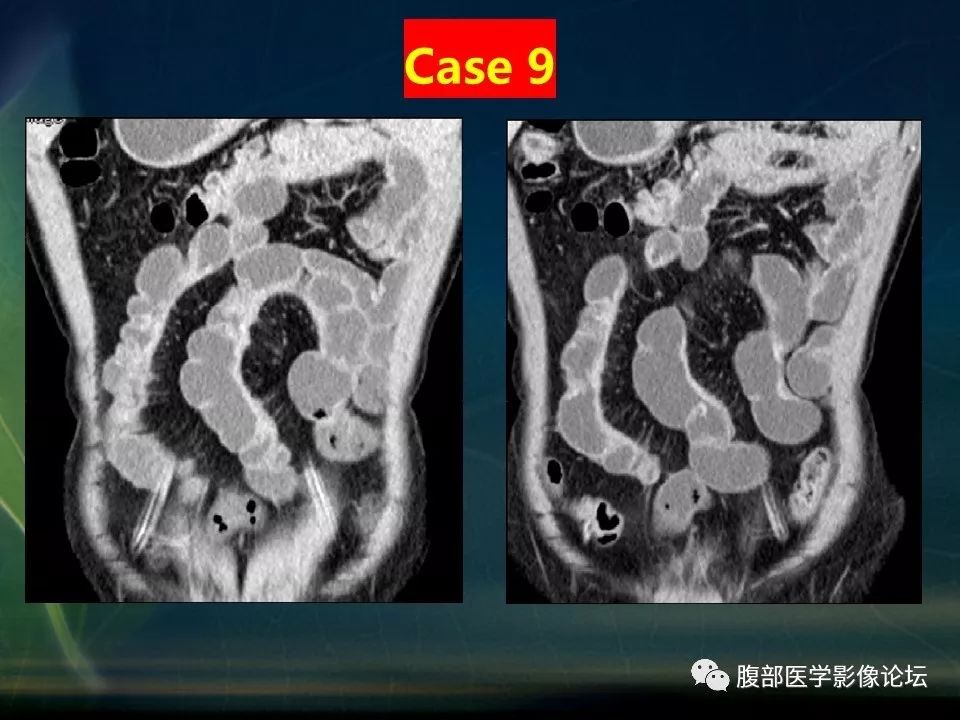 【PPT】小肠疾病读片—克罗恩病、肠结核、溃疡性结肠炎鉴别诊断