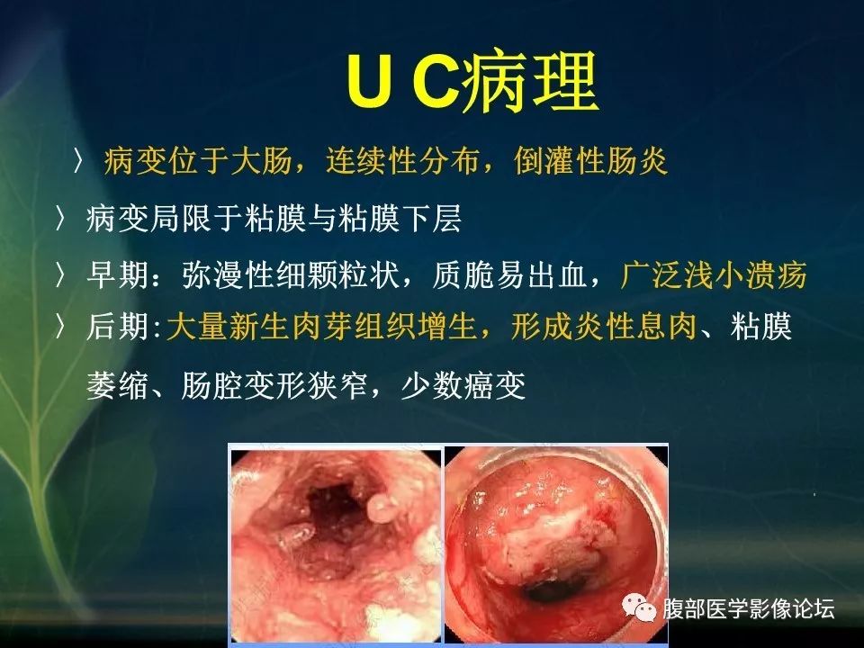 【PPT】小肠疾病读片—克罗恩病、肠结核、溃疡性结肠炎鉴别诊断