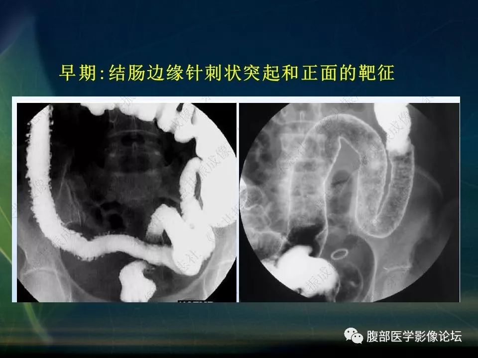 【PPT】小肠疾病读片—克罗恩病、肠结核、溃疡性结肠炎鉴别诊断