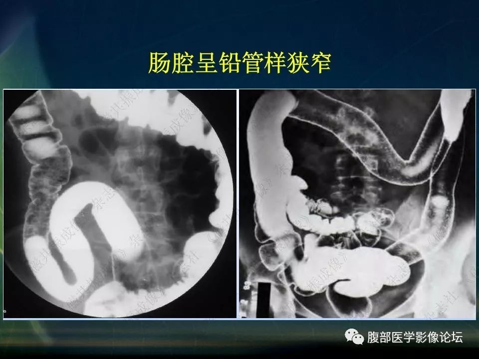 【PPT】小肠疾病读片—克罗恩病、肠结核、溃疡性结肠炎鉴别诊断