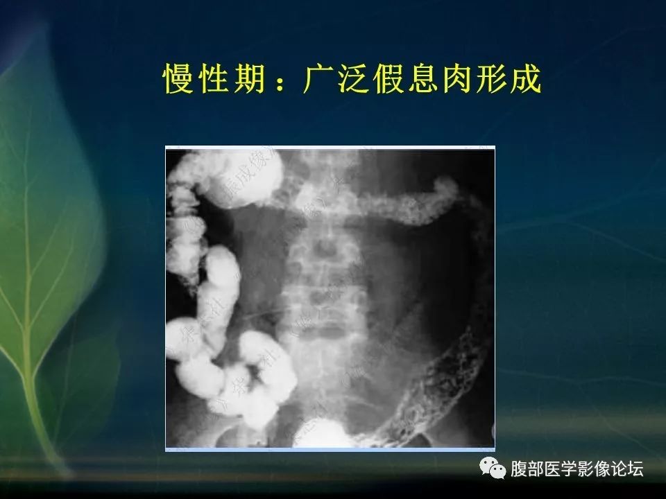 【PPT】小肠疾病读片—克罗恩病、肠结核、溃疡性结肠炎鉴别诊断