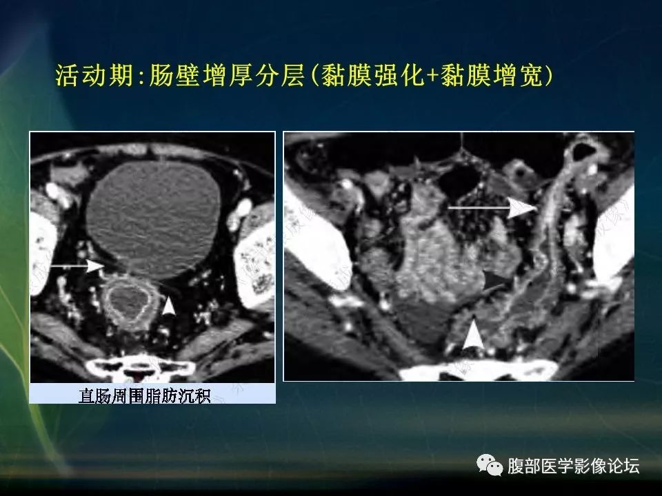 【PPT】小肠疾病读片—克罗恩病、肠结核、溃疡性结肠炎鉴别诊断