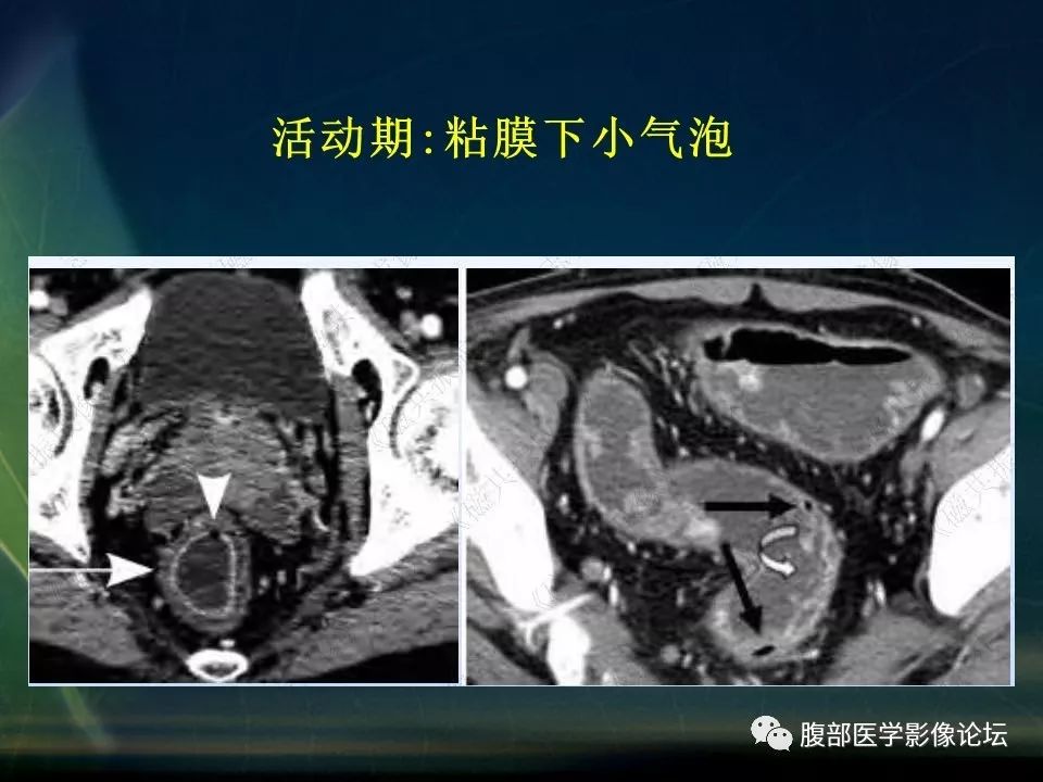 【PPT】小肠疾病读片—克罗恩病、肠结核、溃疡性结肠炎鉴别诊断