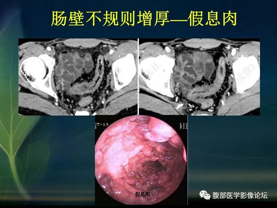 【PPT】小肠疾病读片—克罗恩病、肠结核、溃疡性结肠炎鉴别诊断