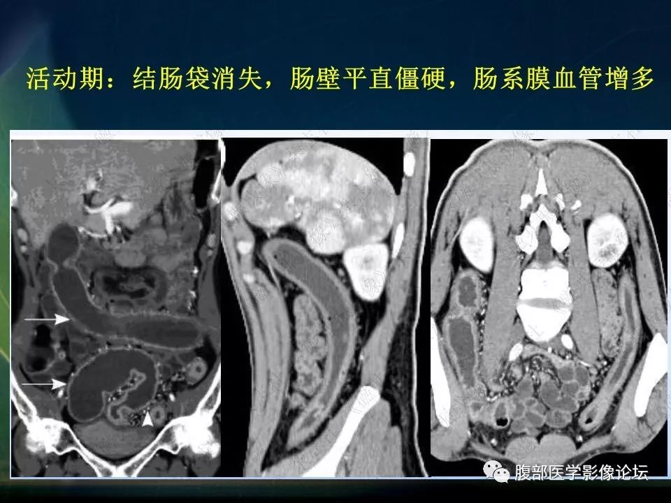 【PPT】小肠疾病读片—克罗恩病、肠结核、溃疡性结肠炎鉴别诊断