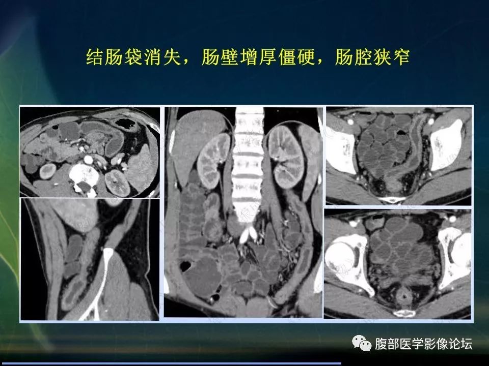 【PPT】小肠疾病读片—克罗恩病、肠结核、溃疡性结肠炎鉴别诊断