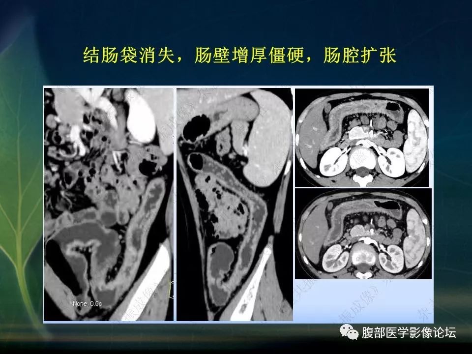 【PPT】小肠疾病读片—克罗恩病、肠结核、溃疡性结肠炎鉴别诊断