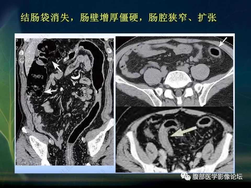 【PPT】小肠疾病读片—克罗恩病、肠结核、溃疡性结肠炎鉴别诊断