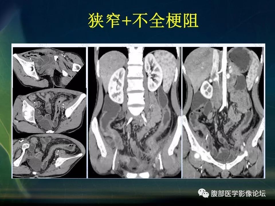 【PPT】小肠疾病读片—克罗恩病、肠结核、溃疡性结肠炎鉴别诊断
