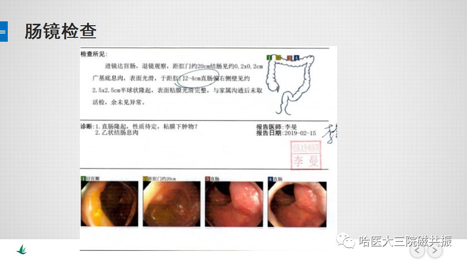 【PPT】胃肠道间质瘤—直肠病例讨论