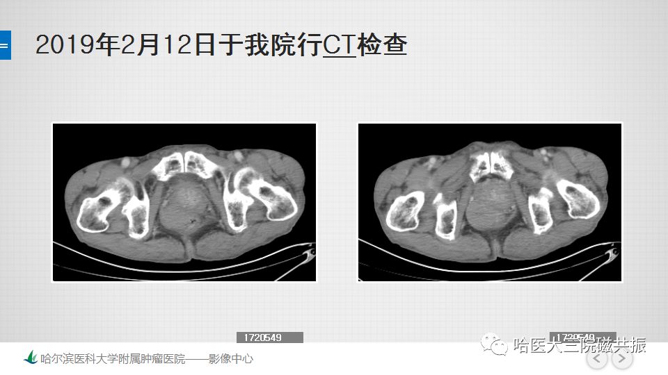 【PPT】胃肠道间质瘤—直肠病例讨论