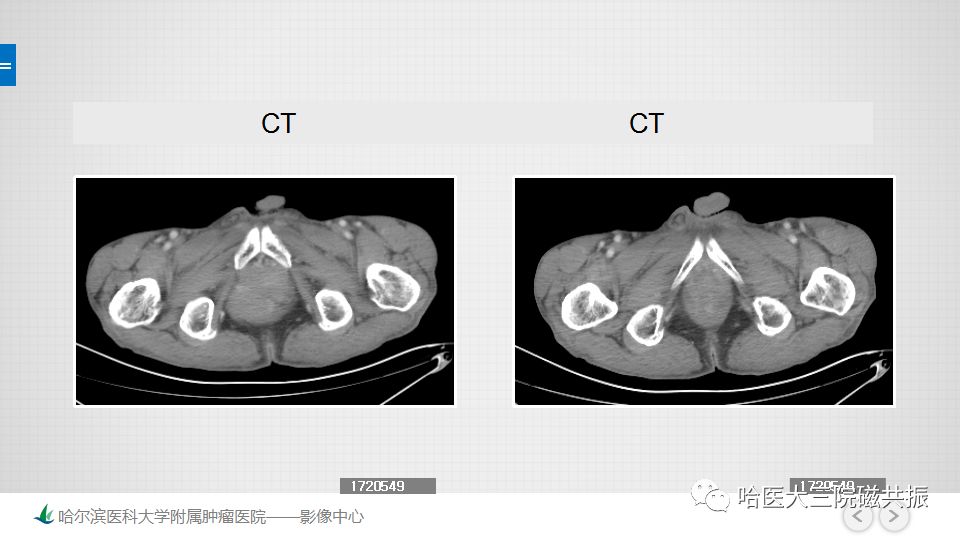 【PPT】胃肠道间质瘤—直肠病例讨论