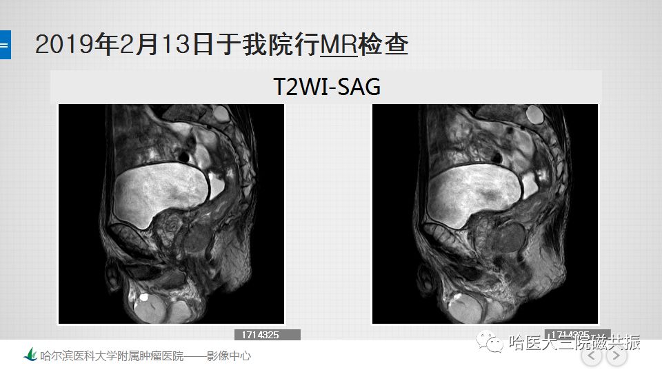 【PPT】胃肠道间质瘤—直肠病例讨论