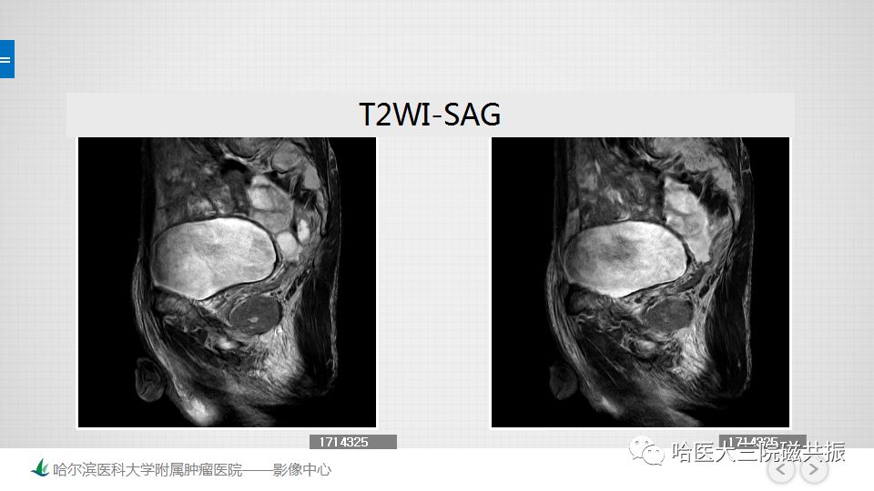 【PPT】胃肠道间质瘤—直肠病例讨论