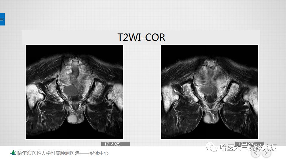 【PPT】胃肠道间质瘤—直肠病例讨论