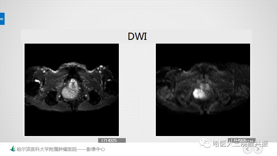 【PPT】胃肠道间质瘤—直肠病例讨论