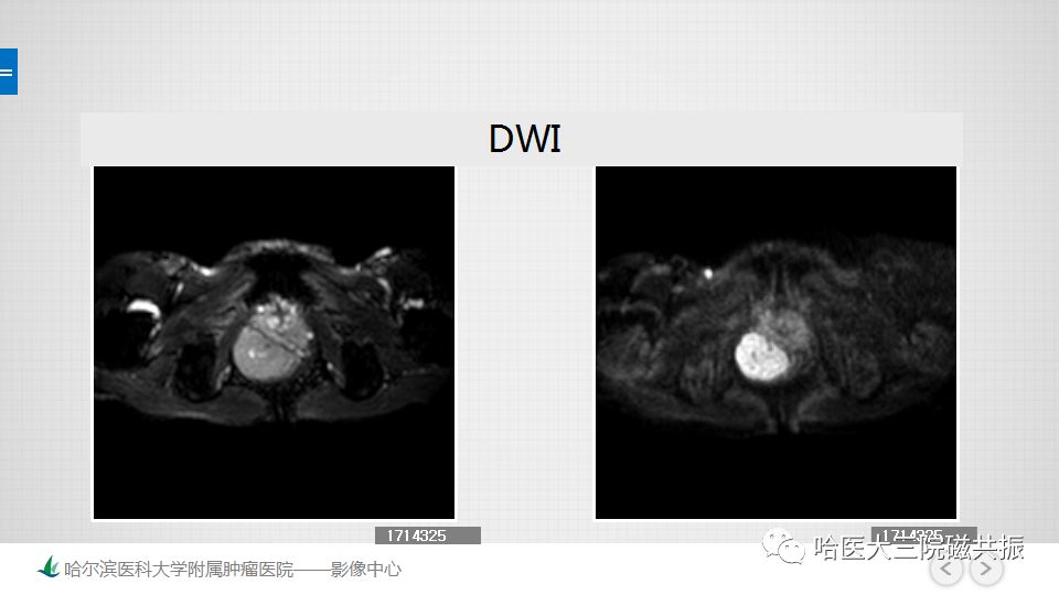【PPT】胃肠道间质瘤—直肠病例讨论