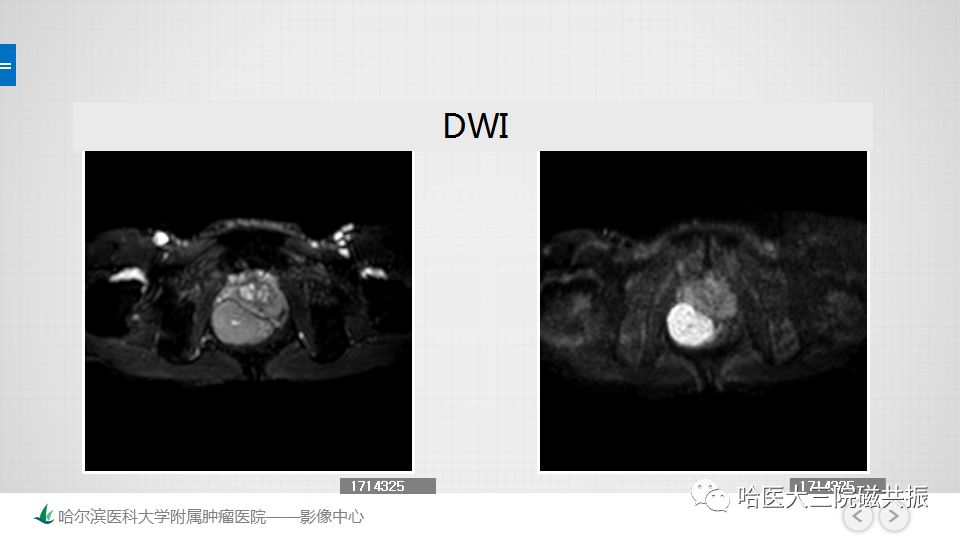【PPT】胃肠道间质瘤—直肠病例讨论