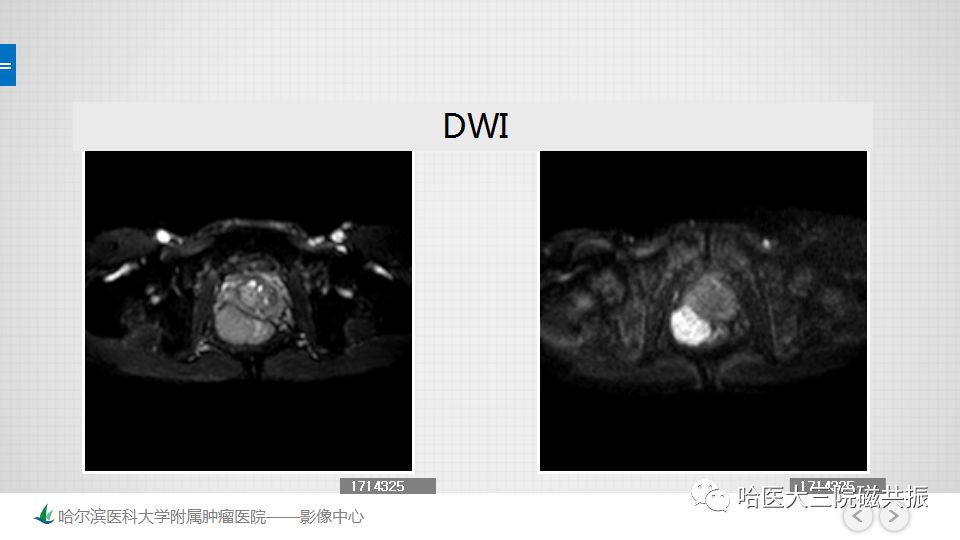 【PPT】胃肠道间质瘤—直肠病例讨论